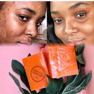 Savon Kojic nettoyant anti acné anti tache